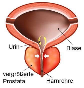 prostata laser op nebenwirkungen