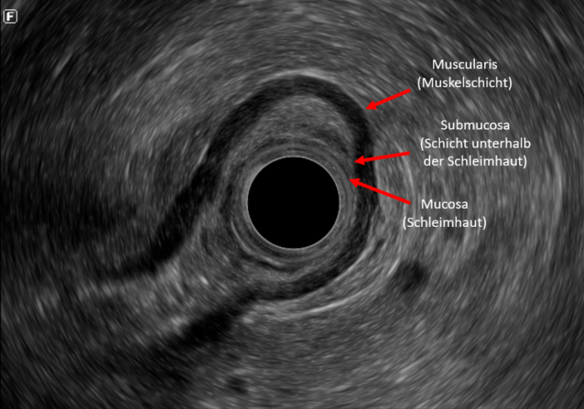 Endosonografie Lipom